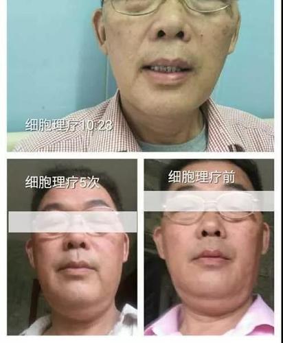 9次,改善甲状腺肿大