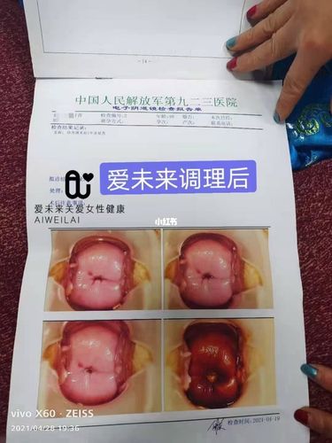 宫颈糜烂支原体感染,用爱未来6_宫颈糜烂_医疗健康
