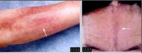 炎65结节性血管炎66荨麻疹性血管炎67鱼鳞病68毛发角化病69汗孔角化