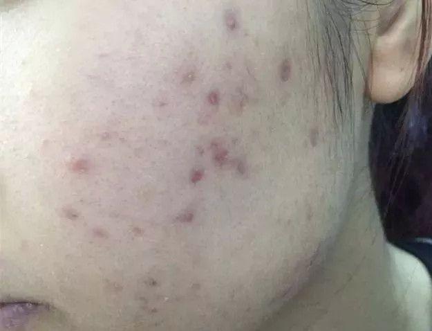 痘印是痘痘发炎后的黑色素沉淀,让长痘痘的地方留下黑色或褐色的颜色