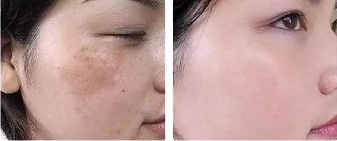 谁说晒斑,雀斑,黄褐斑没救了?用它试试!