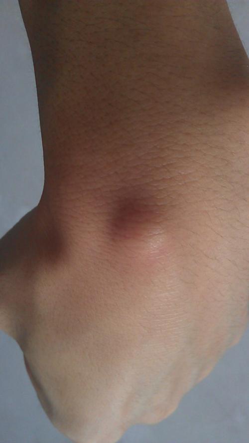 2010-02-24 淋巴结长包包  2013年4月份左右开始,在左手手背皮下手腕