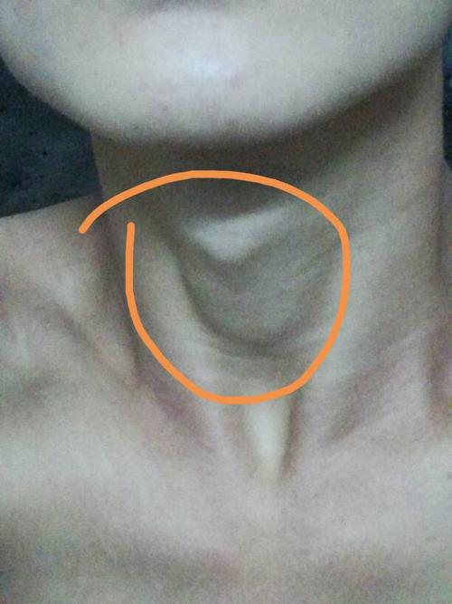 我喉结处怎么会肿起这么大,咽口水不痛,用手去捏就有点痛.是怎么回事?