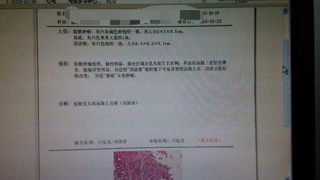 膀胱癌这个情况严重吗