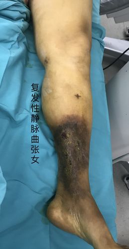 复发性静脉曲张的治疗 王雅南阳市中心医院血管外科