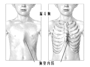 手汗症,漏斗胸治疗可选胸腔镜微创手术