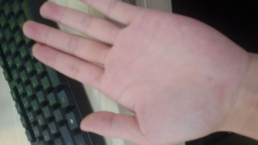 手掌的这种颜色是不是不健康啊?最近看到张肝掌的图片