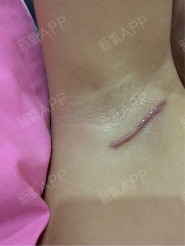 你们的腋下隆胸一样也会留又黑又大条的疤痕吗?我勤奋