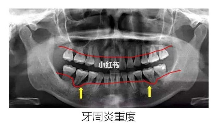 【教你如何通过x光片了解自己的牙周情况】_牙周炎_牙齿保护_口腔