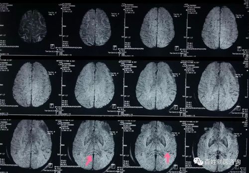 如下图所示: 上图磁共振片,弥漫点状低信号出血点,就是剪切