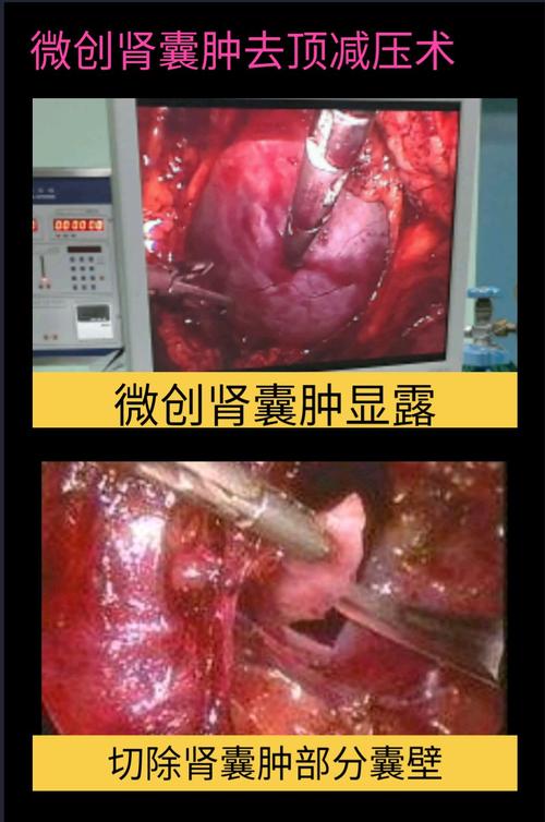 微创囊肿去顶减压术治疗肾囊肿