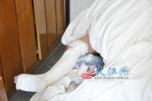 小腿骨折小腿骨折应该怎么办