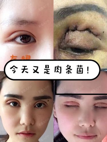 所以双眼皮术后有没有肉条感,也是考验医生技双眼皮肉条和肿的区别