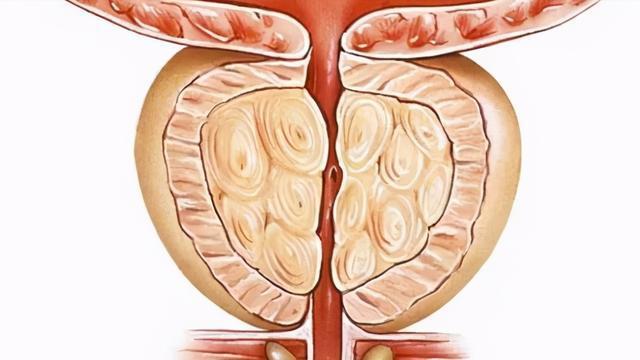 体检报告中的高频词前列腺钙化是什么对健康有影响吗