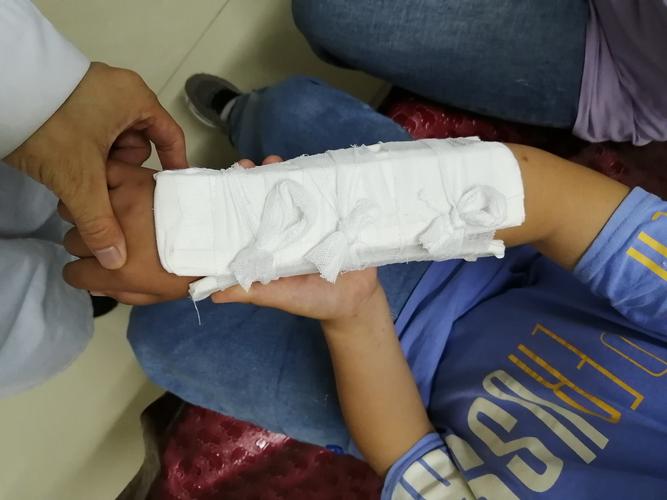 小儿前臂双骨折,手法整复-小夹板固定