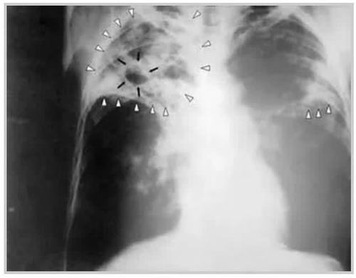 【科普】咳嗽不止,咳痰有血丝.小心是肺结核!