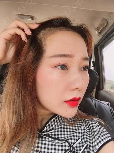 发际线种植术后3天_面部毛发种植术后3天_头部毛发种植术后3天_毛发