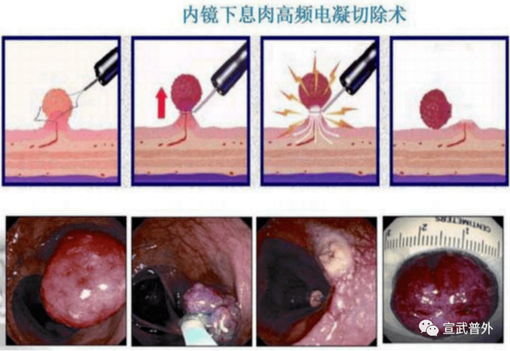 各种有蒂的息肉和腺瘤;直径小于2cm的无蒂息肉和腺瘤 ;多发性腺瘤和