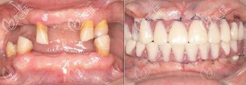 武汉优益佳牙科杨丕波院长全口种植牙真人案例效果对比图