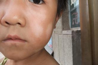 宝宝脸上有白斑宝宝脸上有这症状要小心