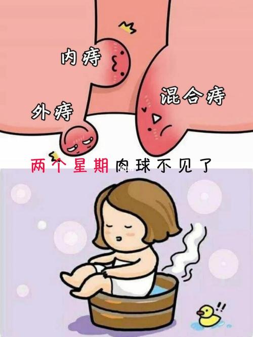 关于痔疮你了解多少96这是我的经验分享_痔疮_我的日常_医疗健康