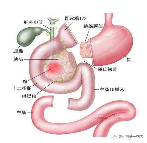 【技术分享】市一院成功开展保留十二指肠全胰头微创切除术