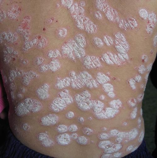 银屑病是一种常见皮肤病,银屑病发生时一定要及时治疗,迁延不治或是