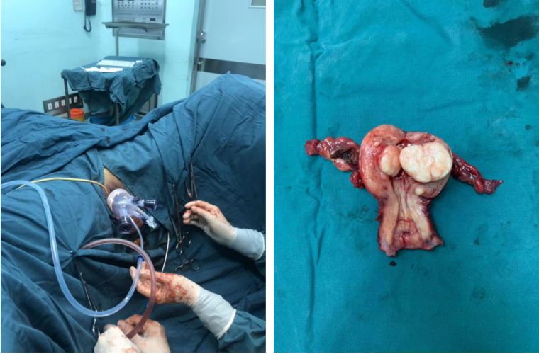 病例分析室no43经阴道自然腔道内镜手术全子宫和双附件切除1例及讨论