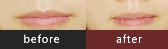 郑州冰点激光脱唇毛 根除尴尬唇毛 尽享亲密距离