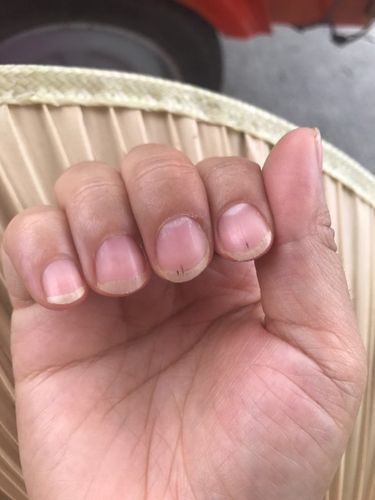指甲里长黑线是怎么回事?