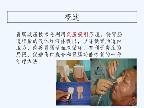 胃肠减压的护理最新ppt课件