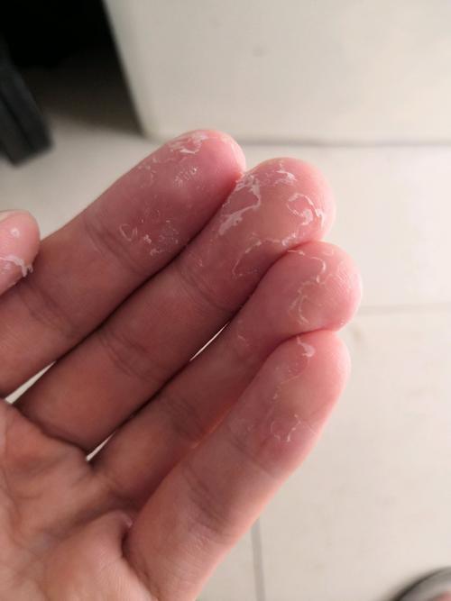 不过这种脱皮症状较轻,只是手指或脚趾的轻度脱皮,没有红疹,也不痒