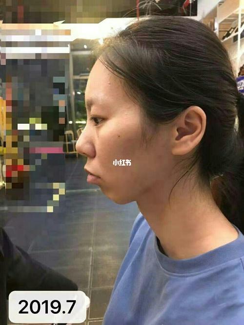 骨性龅牙,牙套130天侧脸效果对比_整牙_牙套_龅牙_侧脸_牙齿矫正_美妆