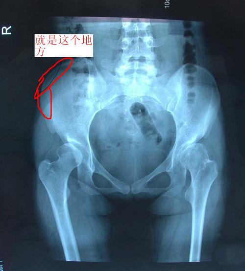 几个月前在学校运动会上跑完一百米后,大腿外侧上面接近腰部的骨头就