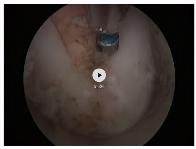 神经根受压上肢麻痛剧烈,脊柱内镜微创治疗不开刀!_手术