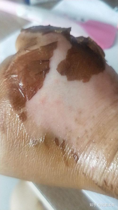 二度烫伤后恢复过程