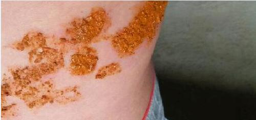 蛇胆疮图片,蛇胆疮初期后期图片大全识别!