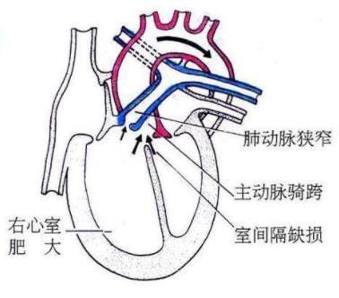 法洛三四五联征超声特点