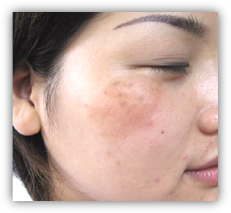 > 皮肤科 > 黄褐斑 > 发作  俗话说三分治七分养,在黄褐斑治疗方面尤