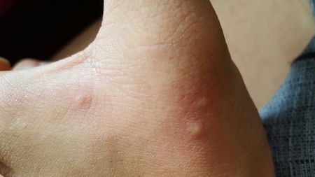 这是不是干疮子?很小的,透明的