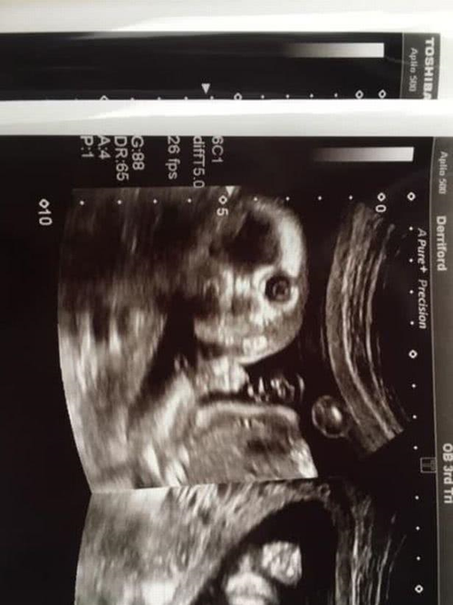 英国准妈妈怀孕20周,b超照片太好玩,胎儿直视镜头像小鬼