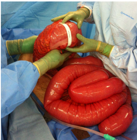 61岁老汉腹部胀成大气球?剖腹探查肠子竟长这样 | 腹里乾坤