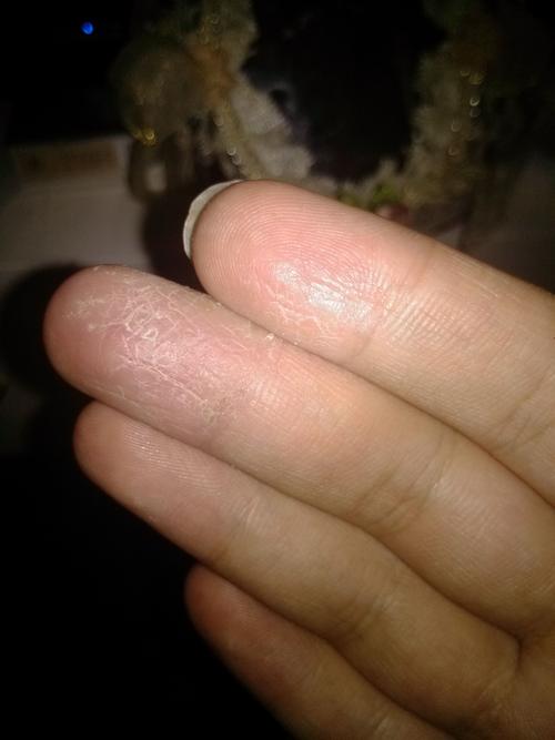 手指脱皮,龟裂,很痒,有几个月了