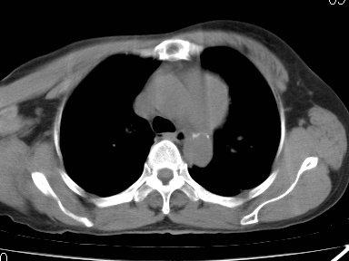 ct4228158f胸片示主动脉弓增宽主动脉瘤未排除纵
