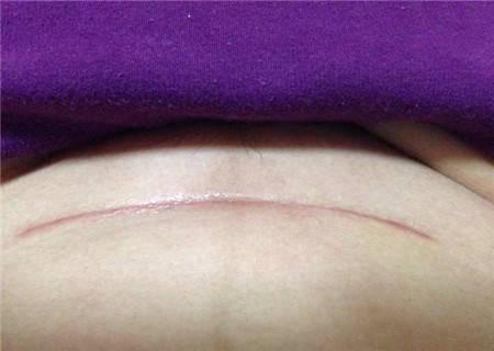 剖腹产的"横切"和顺产的"侧切"哪个恢复早,四个不同