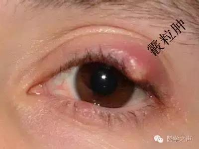 "一字之差"麦粒肿 vs 霰粒肿!