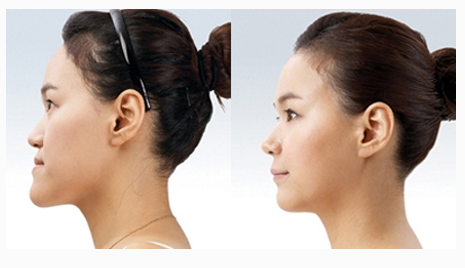 地包天牙齿矫正有没有年龄限制