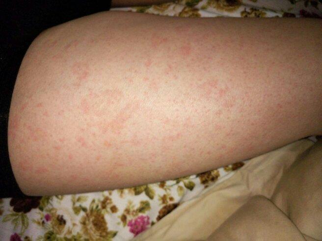 我皮肤有点干燥,有穿多带绒的衣服是不是皮肤过敏啊?