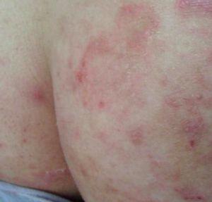 原因/腹股沟痒 编辑 发病原因 股癣的主要病原菌为红色毛癣菌和须癣毛