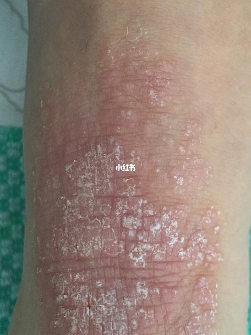 神经性皮炎 这个神经性皮炎真是太烦人了,哎,腿上突然